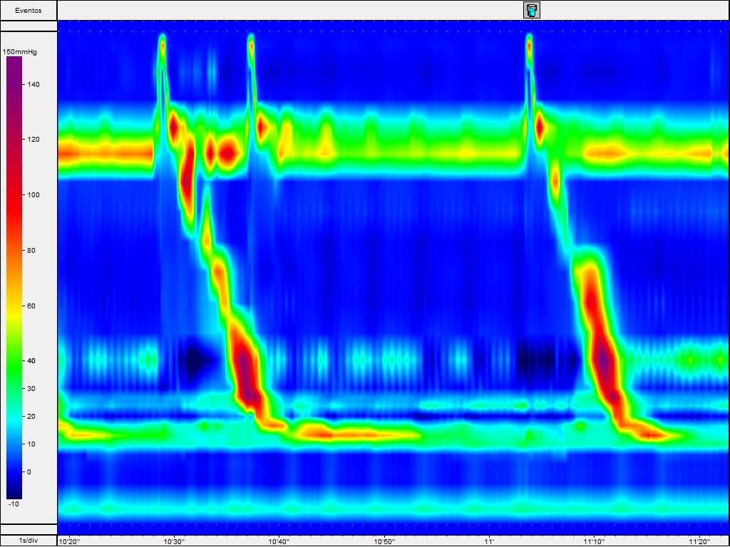 Manometria Esofágica (MAR)